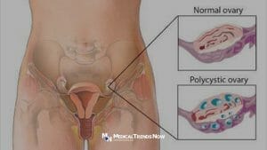 How PCOS is diagnosed in the Philippines?