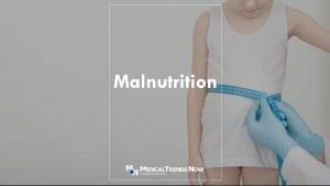 malnutrition icd 10