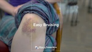 Easy bruising anemia 