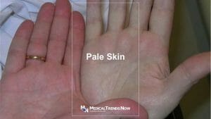 Pale skin