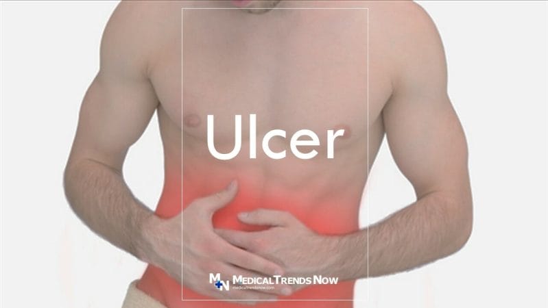 What Causes Ulcers - Stomach Ulcer Symptoms