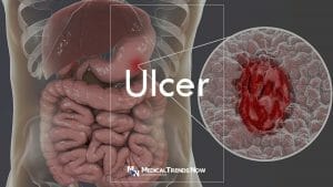 Stomach (Peptic) Ulcers: Symptoms, Causes, and Treatment