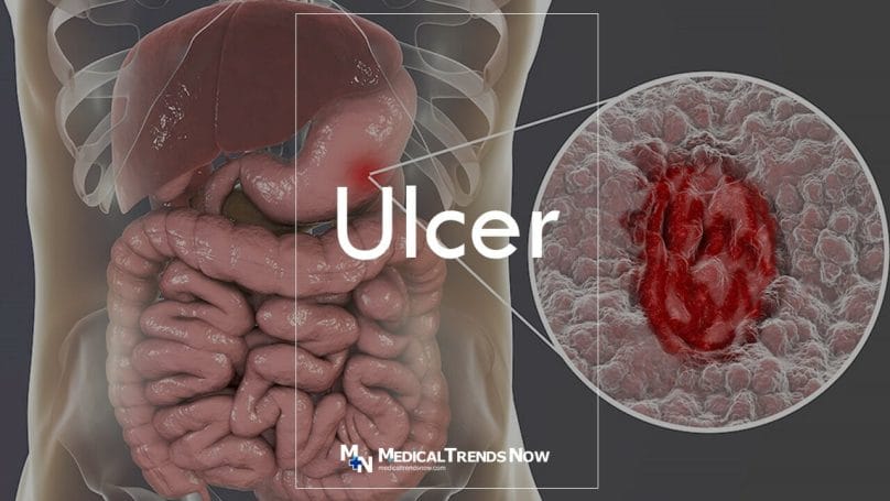 Stomach (Peptic) Ulcers: Symptoms, Causes, and Treatment