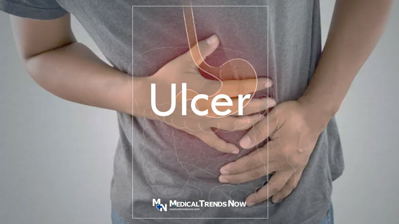 10 natural and home remedies for ulcers