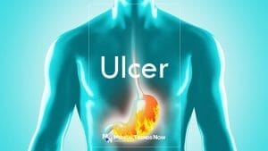 How To Relieve Stomach Ulcers Fast 