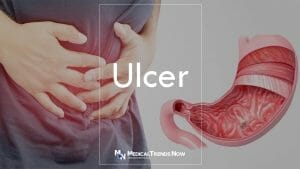 Peptic ulcer - Symptoms and causes