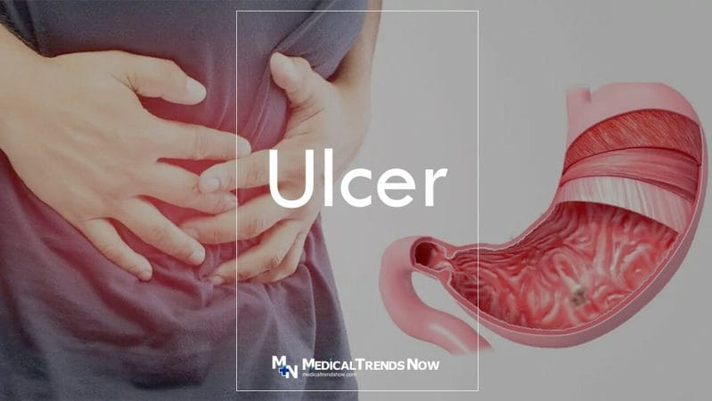 Peptic ulcer - Symptoms and causes