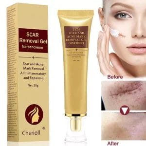 Scar Cream, Acne Scar Removal Cream,Acne Spots Treatment,Stretch Marks Relief and Burns Repair,Face Skin Repair Cream 30ml