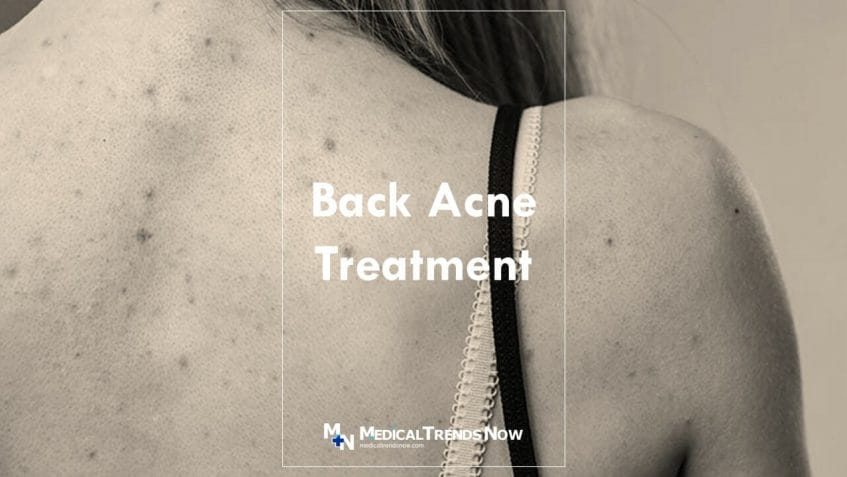 Chest or Back: How to Get Rid of Body Acne
