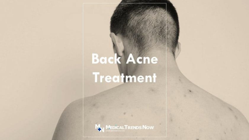 Acne Vulgaris on your back - Dermatologic Disorders