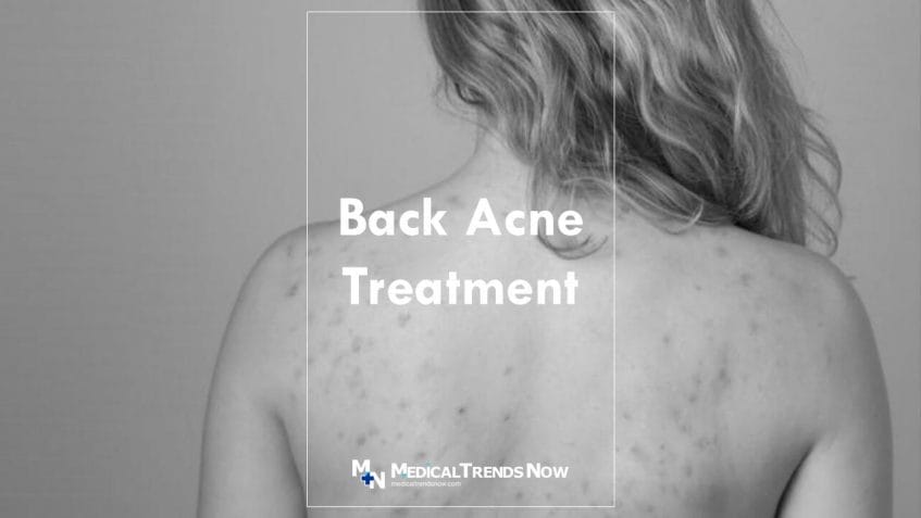 Back and Body Acne Causes and Treatments
