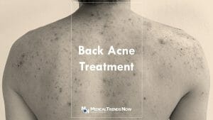 Diagnosis and Treatment of Acne