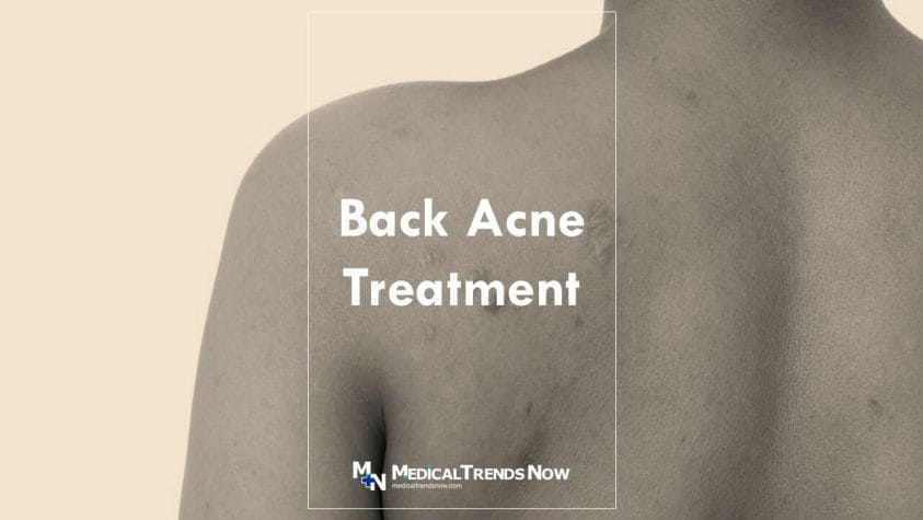 How to Get Rid of Bacne - Best Back Acne Treatments