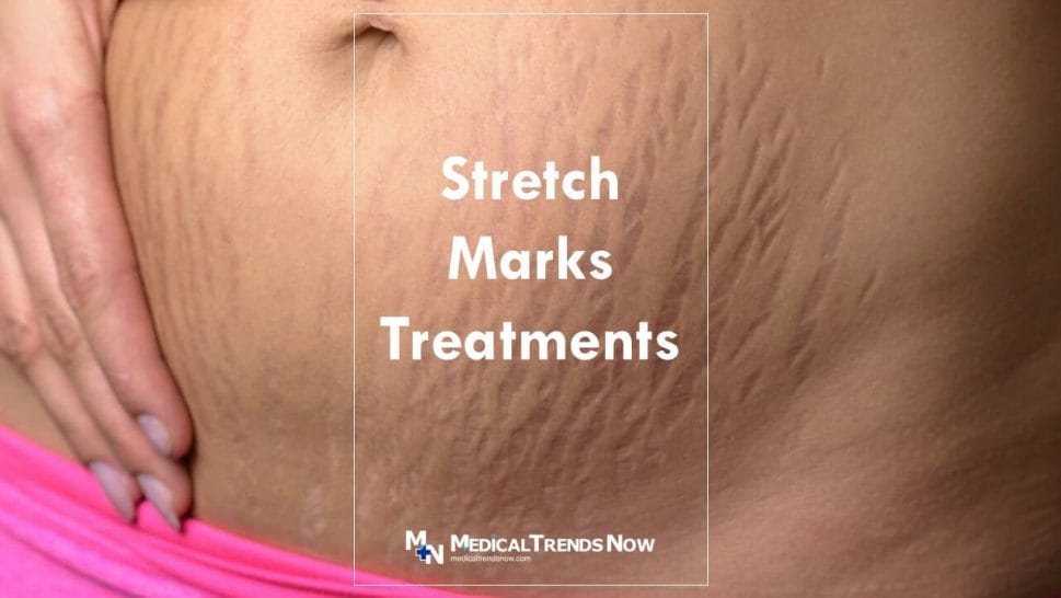 Striae Distensae Treatment