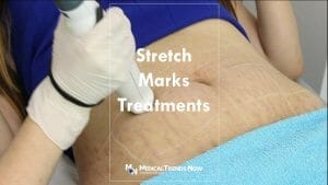 Striae Distensae Treatment