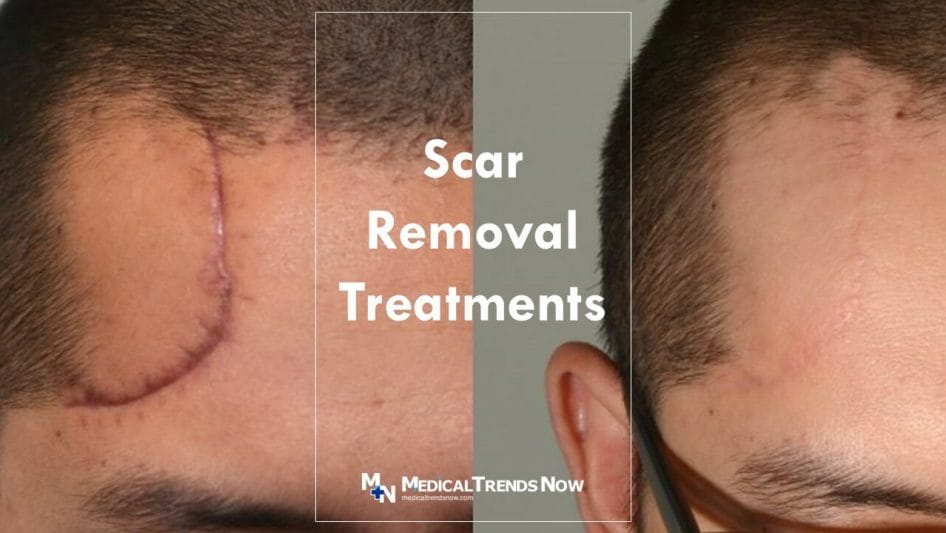 List of Scar Removal Prices and Rates in Derma