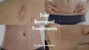 8 Natural Remedies for Scar Removal