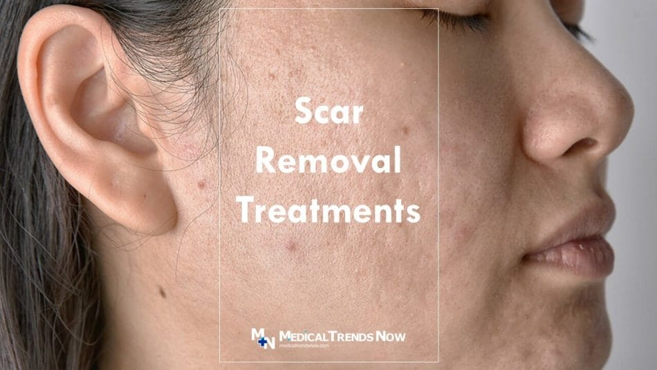 Types of Scars and Their Treatments