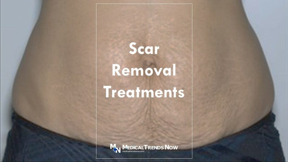 10 things to know before having laser treatment for your scar