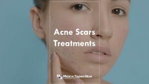 acne treatment