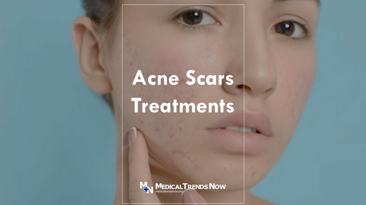 Treatments for Acne Scars in the Philippines - Medical Trends Now