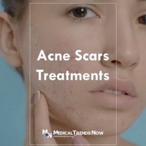Treatments for Acne Scars in the Philippines