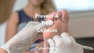 Corns and calluses - Symptoms and causes