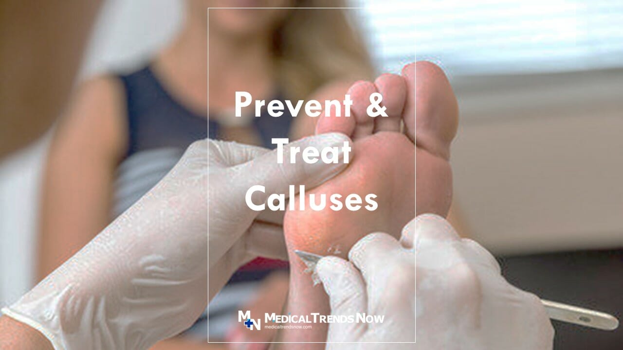 Corns and calluses - Symptoms and causes