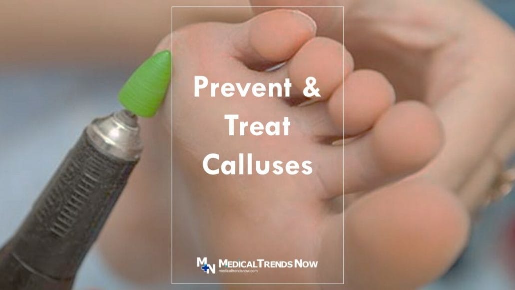 Corns and Calluses: Symptoms, Treatment & Care Tips 