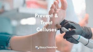 Corns and calluses: What's the difference and how can I treat them 