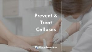 How to treat corns and calluses 