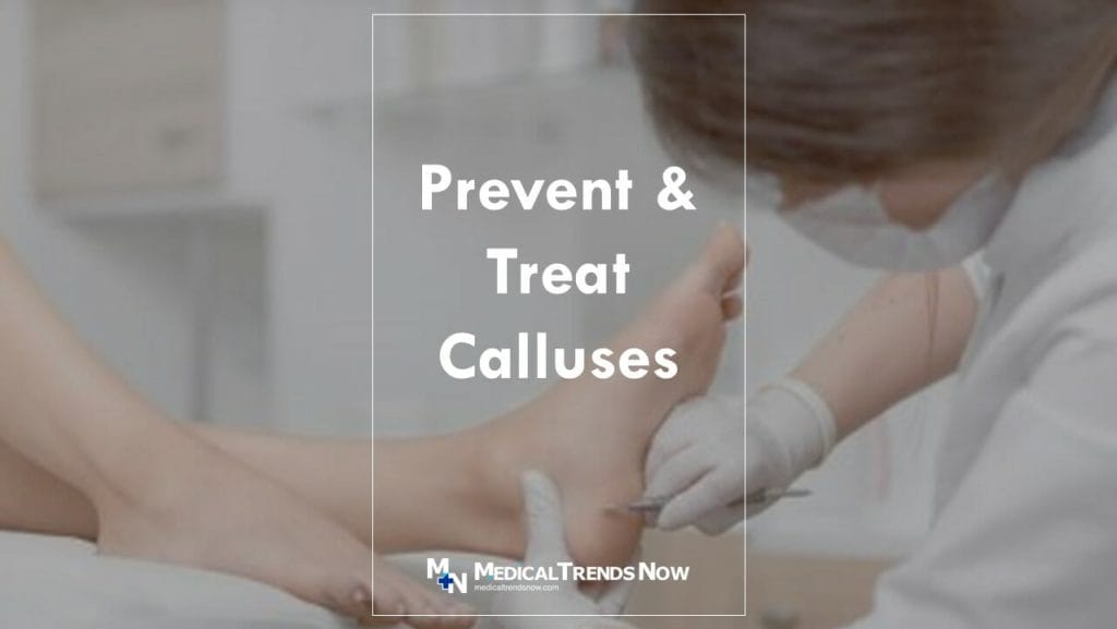 How to treat corns and calluses 