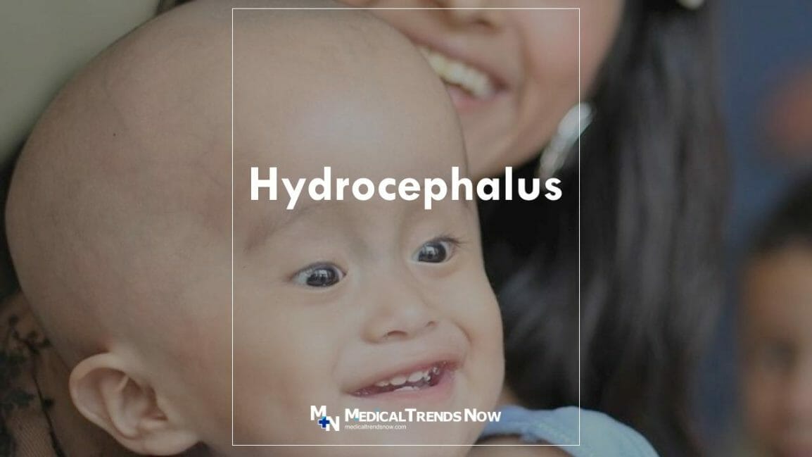 What Is Hydrocephalus What Causes It And Is It Life Threatening