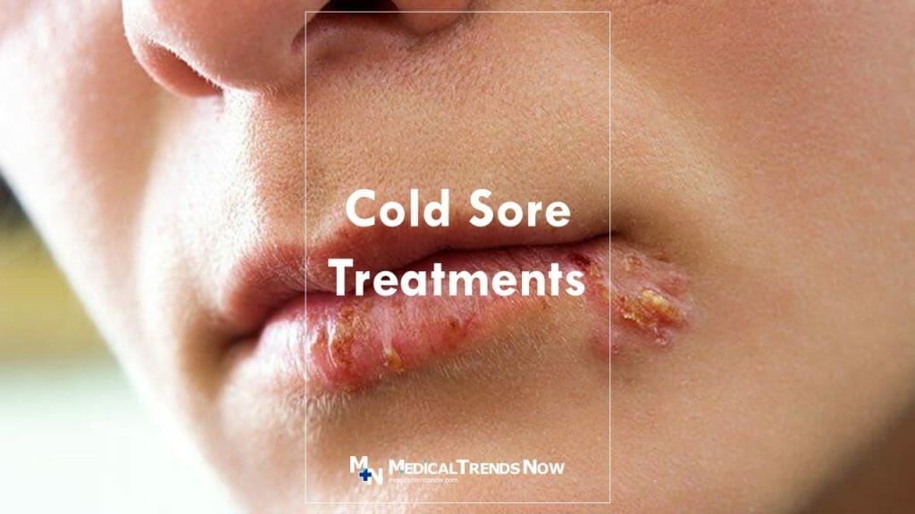 How to Treat Cold Sores: What You Should Know and What to Do - Medical ...