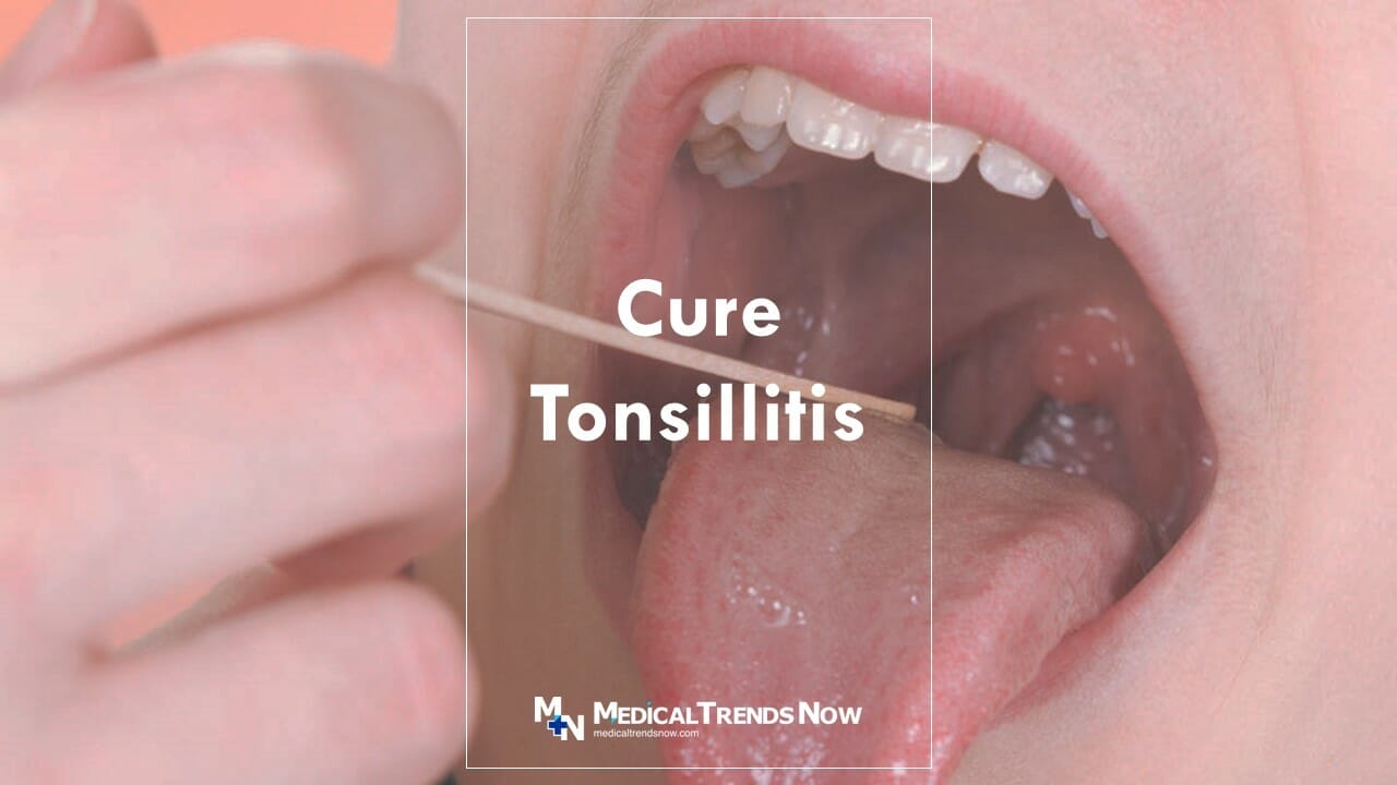 treatment for Tonsillitis