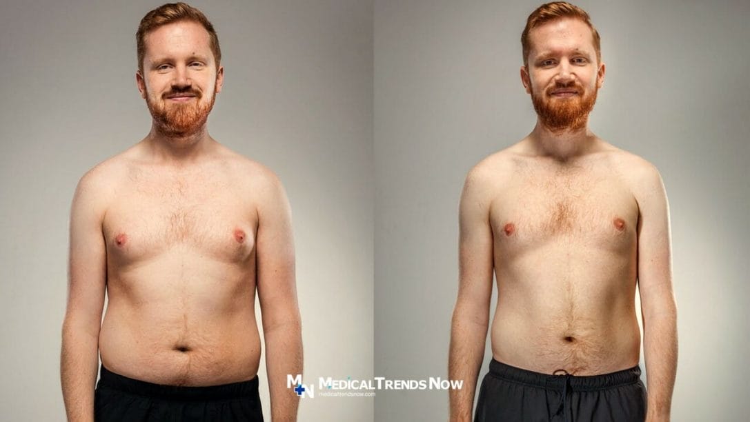 lose weight before and after in the Philippines