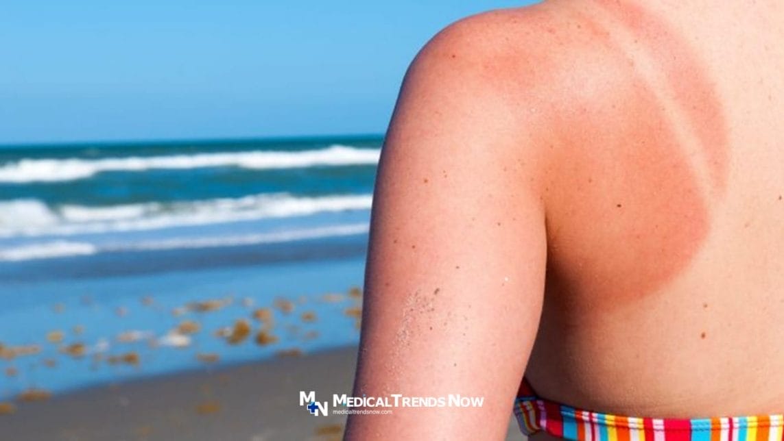 Avoid Sunburn In Summertime in the Philippines