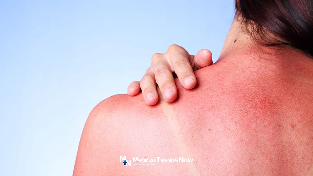 Prevent Sunburn In Summertime in the Philippines