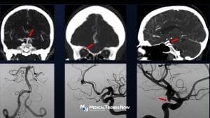 Aneurysm brain scan in the Philippines